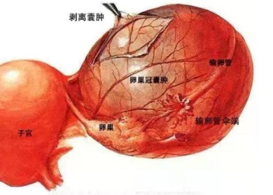 卵巢多发性囊肿