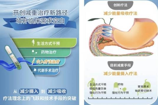 胃转流支架