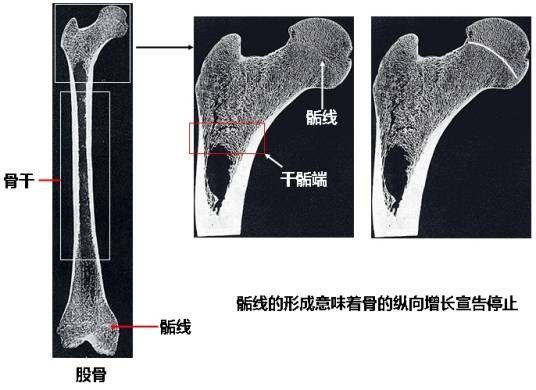 骺线