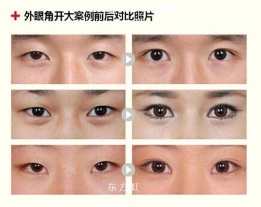 开外眼角