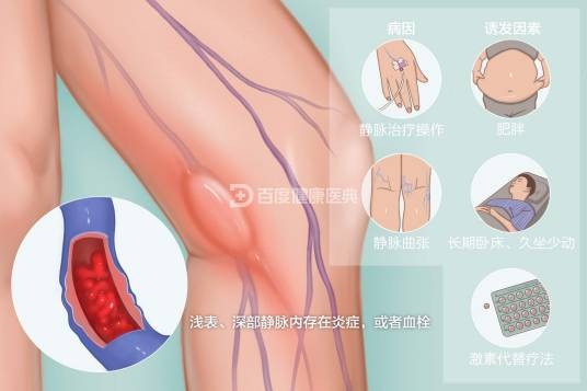 静脉炎