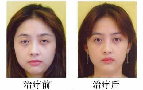 激光去眼袋