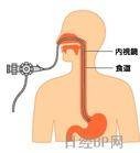 鼻内窥镜