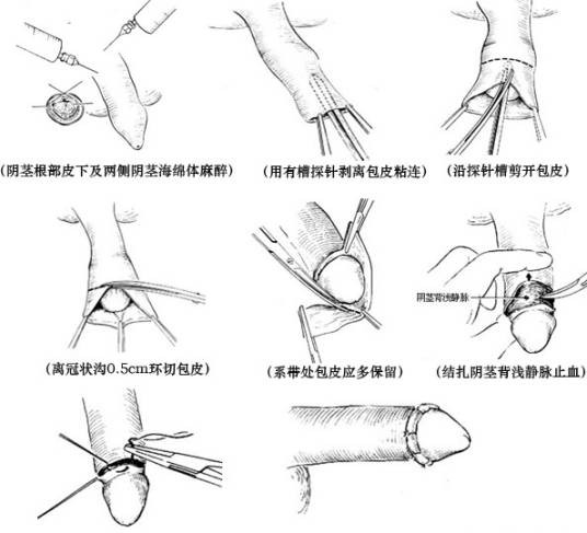 包皮手术