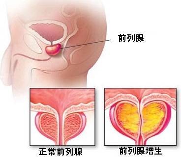 前列腺增生肥大
