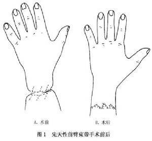 先天性束带综合征