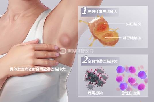 淋巴结肿大