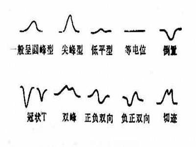t波