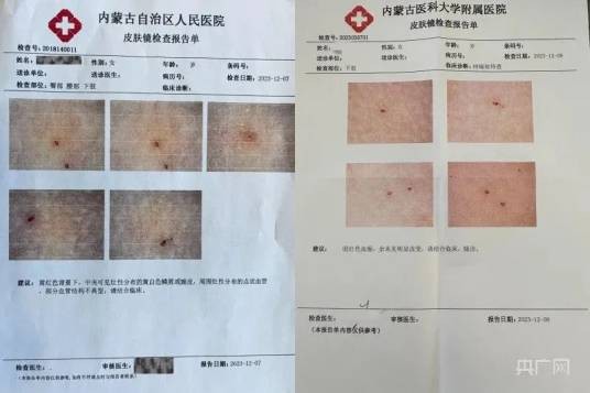 12·6呼和浩特幼儿园女童身上出现针眼事件